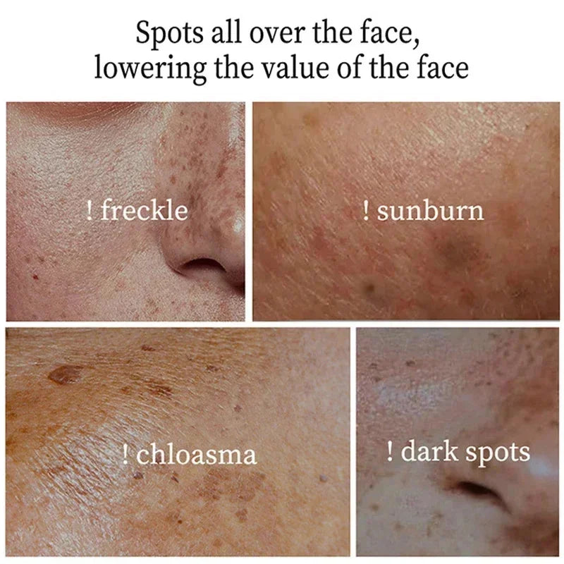 Whitening Freckle Cream Face Brightening Cream Niacinamide Reduce Chloasma Melasma Melanin Fade Fine Lines Lighten Dark Skincare