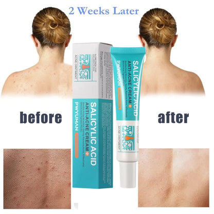 Herbal Acne Removal Face Cream Clears Pimple Scar Black Dots Gel Acne Treatment Shrink Pore Skin Whitening Lightening Ointment
