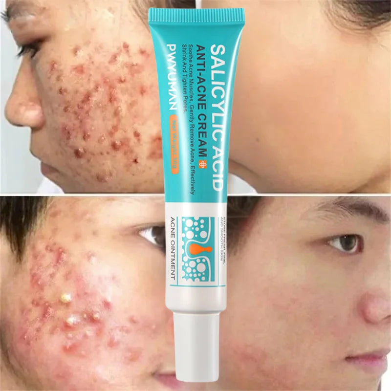 Herbal Acne Removal Face Cream Clears Pimple Scar Black Dots Gel Acne Treatment Shrink Pore Skin Whitening Lightening Ointment