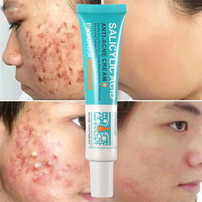 Herbal Acne Removal Face Cream Clears Pimple Scar Black Dots Gel Acne Treatment Shrink Pore Skin Whitening Lightening Ointment