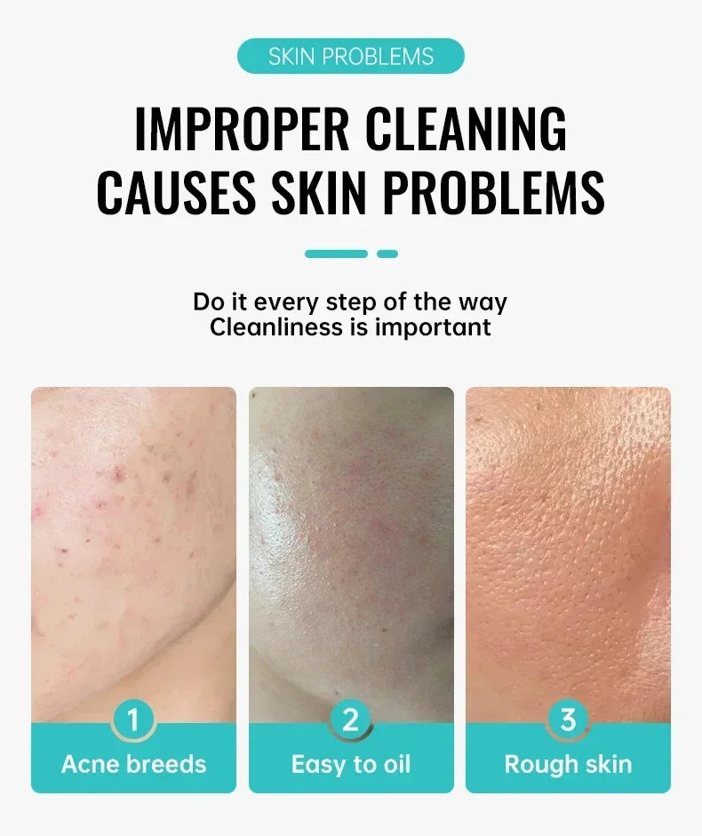 Herbal Acne Removal Face Cream Clears Pimple Scar Black Dots Gel Acne Treatment Shrink Pore Skin Whitening Lightening Ointment