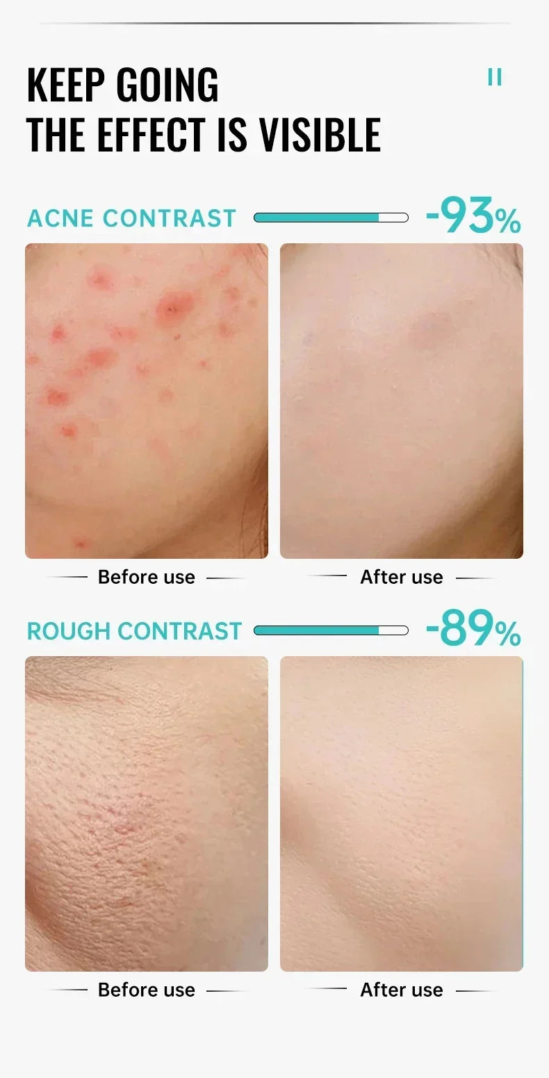 Herbal Acne Removal Face Cream Clears Pimple Scar Black Dots Gel Acne Treatment Shrink Pore Skin Whitening Lightening Ointment