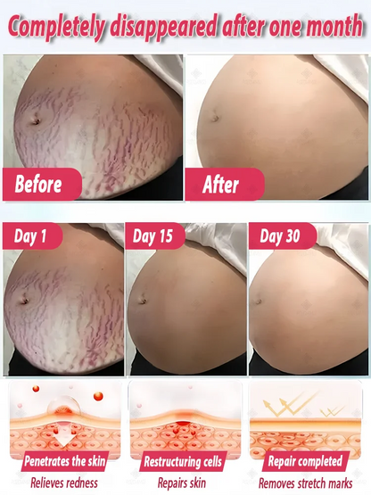 Stretch mark repair, easy removal at home