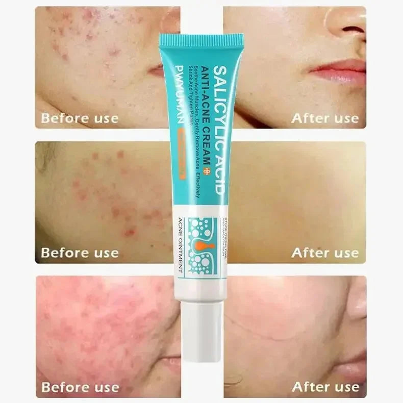 Herbal Acne Removal Face Cream Clears Pimple Scar Black Dots Gel Acne Treatment Shrink Pore Skin Whitening Lightening Ointment