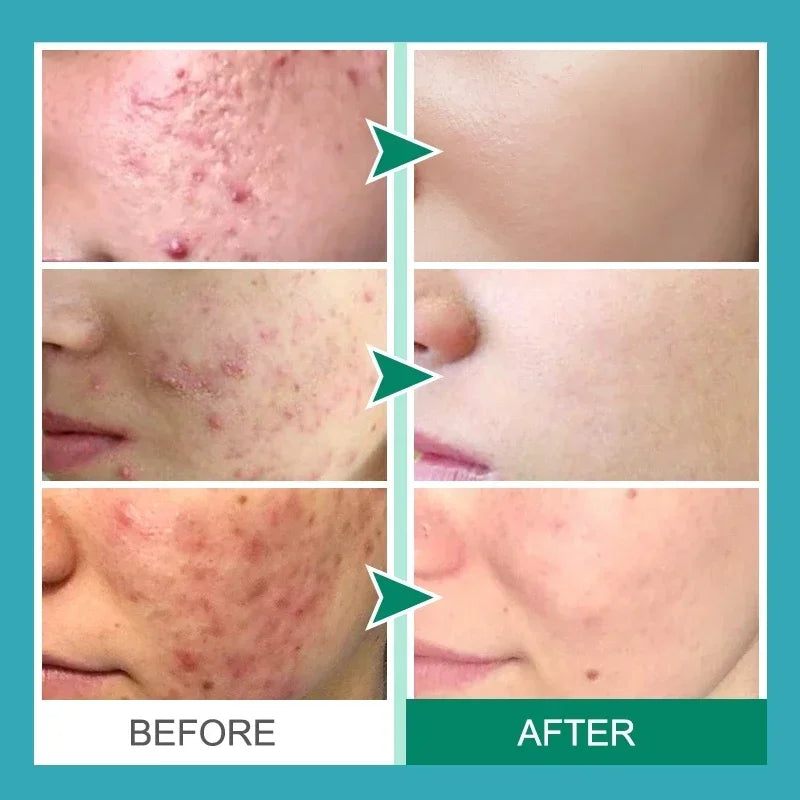 Herbal Acne Removal Face Cream Clears Pimple Scar Black Dots Gel Acne Treatment Shrink Pore Skin Whitening Lightening Ointment