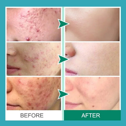 Herbal Acne Removal Face Cream Clears Pimple Scar Black Dots Gel Acne Treatment Shrink Pore Skin Whitening Lightening Ointment