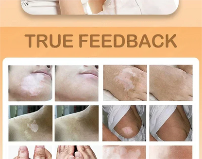 Vitiligo cream, men's and women's skin care essence