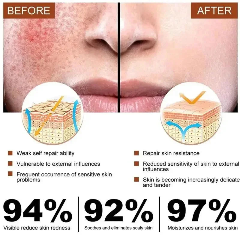 Repair Facial Redness Cream Instant Spider Vein Remove Sensitive Skin Sooth Anti Redness Rosacea Treat Lotion Korean Cosmetics