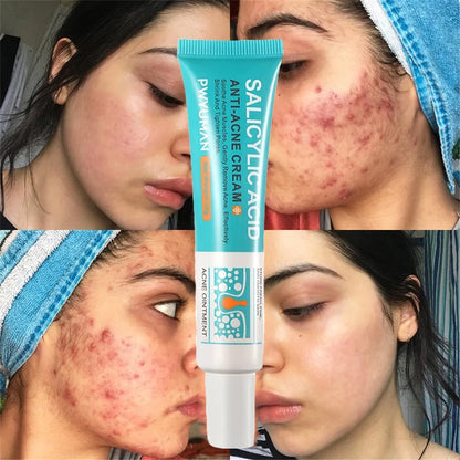 Herbal Acne Removal Face Cream Clears Pimple Scar Black Dots Gel Acne Treatment Shrink Pore Skin Whitening Lightening Ointment