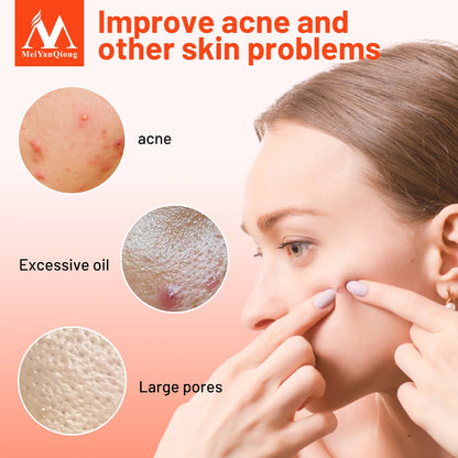 Acne Cream Acne Removal Eliminate Acne Marks Repair Damaged Skin Moisturizing Nourishing Whitening Skin Rejuvenating Face Care