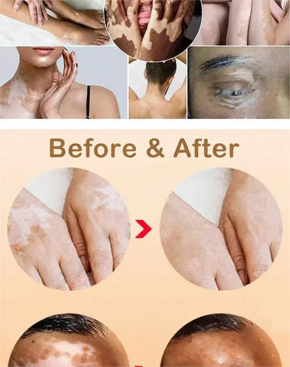 Vitiligo cream, men's and women's skin care essence
