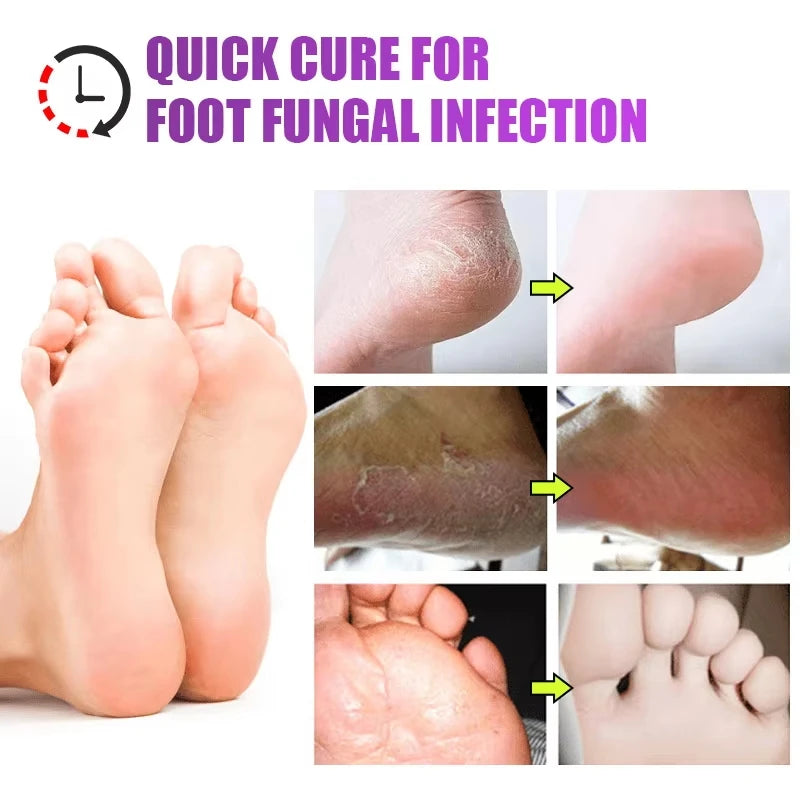 Herbal Anti Crack Foot Cream Spray Heel Cracking Repair Products Exfoliation Dead Skin Removal Softening Moisturize Smooth Care