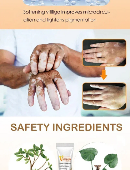 Vitiligo cream, men's and women's skin care essence