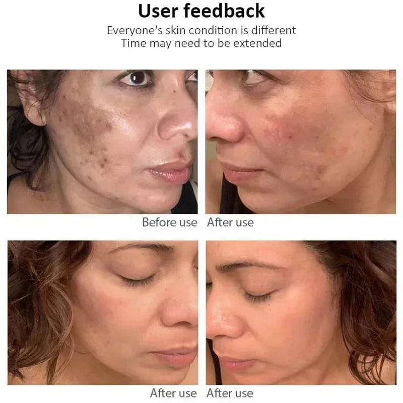 Whitening Freckle Cream Face Brightening Cream Niacinamide Reduce Chloasma Melasma Melanin Fade Fine Lines Lighten Dark Skincare