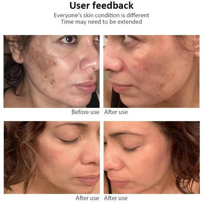 Whitening Freckle Cream Face Brightening Cream Niacinamide Reduce Chloasma Melasma Melanin Fade Fine Lines Lighten Dark Skincare