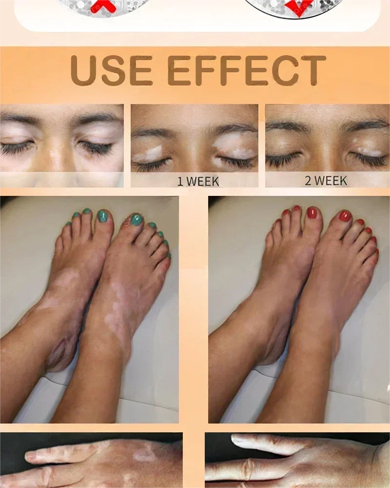 Vitiligo cream, men's and women's skin care essence