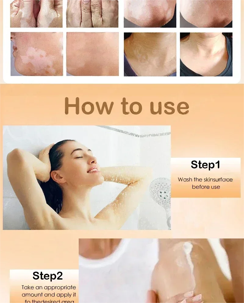 Vitiligo cream, men's and women's skin care essence