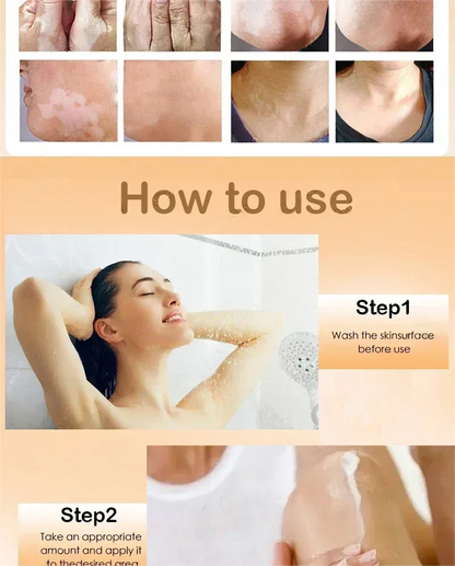 Vitiligo cream, men's and women's skin care essence