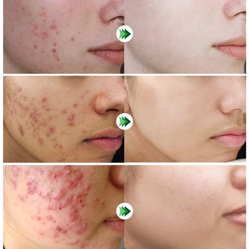 Herbal Acne Removal Face Cream Clears Pimple Scar Black Dots Gel Acne Treatment Shrink Pore Skin Whitening Lightening Ointment