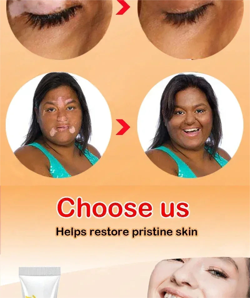 Vitiligo cream, men's and women's skin care essence