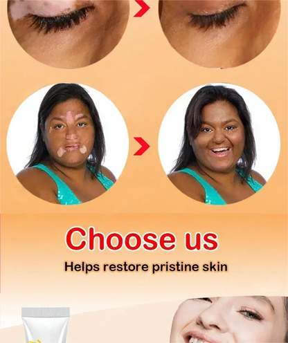 Vitiligo cream, men's and women's skin care essence
