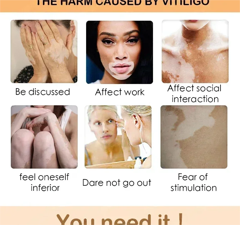 Vitiligo cream, men's and women's skin care essence
