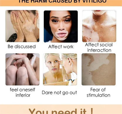 Vitiligo cream, men's and women's skin care essence