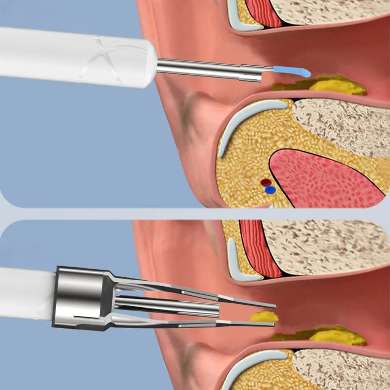 Wireless Ear Cleaner with Camera Ear Spoons and Clips WiFi Connection Waterproof Rechargeable Ear Wax Removal Tool