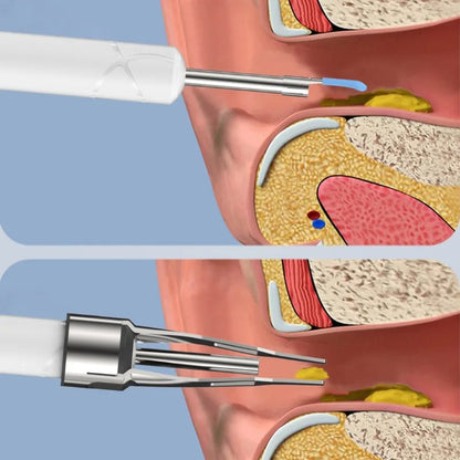 Wireless Ear Cleaner with Camera Ear Spoons and Clips WiFi Connection Waterproof Rechargeable Ear Wax Removal Tool