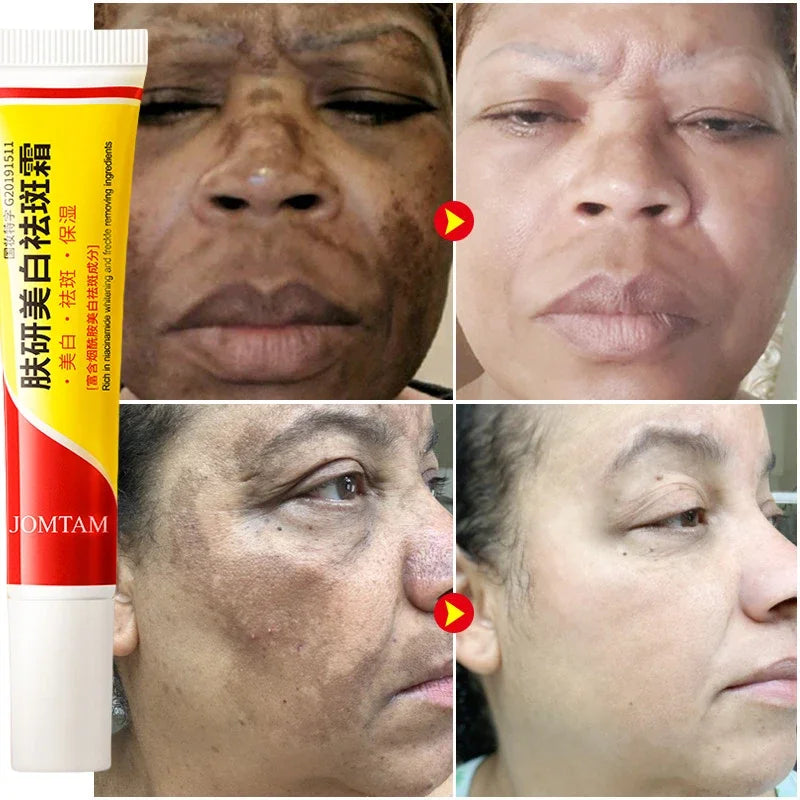 Whitening Freckle Cream Face Brightening Cream Niacinamide Reduce Chloasma Melasma Melanin Fade Fine Lines Lighten Dark Skincare