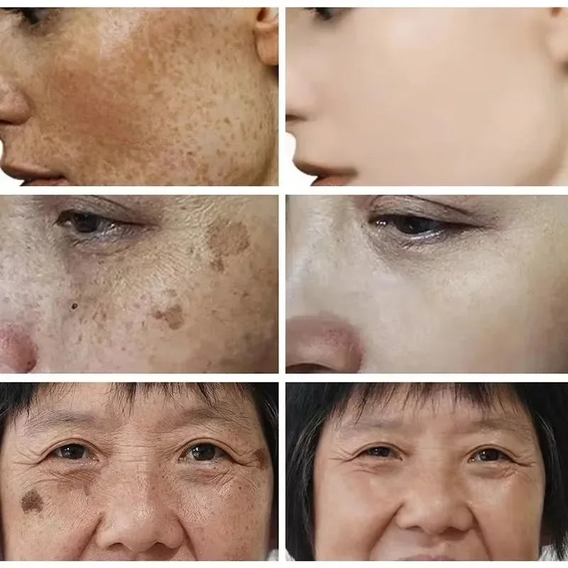 Whitening Freckle Cream Face Brightening Cream Niacinamide Reduce Chloasma Melasma Melanin Fade Fine Lines Lighten Dark Skincare