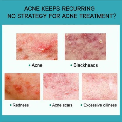 Herbal Acne Removal Face Cream Clears Pimple Scar Black Dots Gel Acne Treatment Shrink Pore Skin Whitening Lightening Ointment