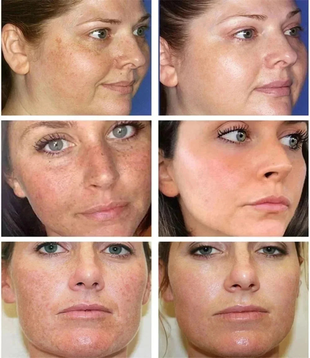 Whitening Freckle Cream Face Brightening Cream Niacinamide Reduce Chloasma Melasma Melanin Fade Fine Lines Lighten Dark Skincare