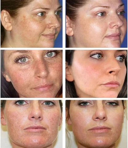 Whitening Freckle Cream Face Brightening Cream Niacinamide Reduce Chloasma Melasma Melanin Fade Fine Lines Lighten Dark Skincare