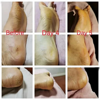 Herbal Anti Crack Foot Cream Spray Heel Cracking Repair Products Exfoliation Dead Skin Removal Softening Moisturize Smooth Care