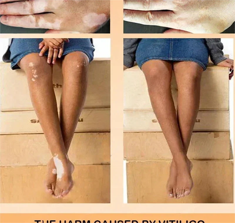 Vitiligo cream, men's and women's skin care essence