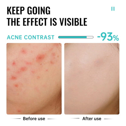 Herbal Acne Removal Face Cream Clears Pimple Scar Black Dots Gel Acne Treatment Shrink Pore Skin Whitening Lightening Ointment