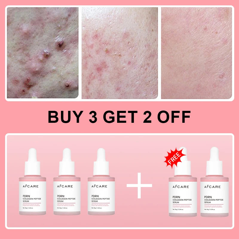 Complex Peptide Acne Serum PDRN Collagen Shrink Pores Fade Melanin Smooth Brightening Skin Korean Skincare Products