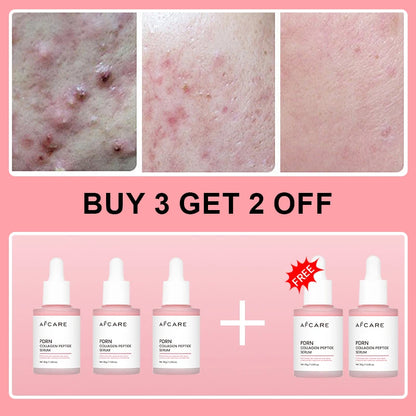 Complex Peptide Acne Serum PDRN Collagen Shrink Pores Fade Melanin Smooth Brightening Skin Korean Skincare Products