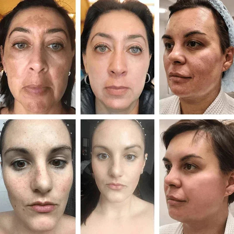 Whitening Freckle Cream Face Brightening Cream Niacinamide Reduce Chloasma Melasma Melanin Fade Fine Lines Lighten Dark Skincare