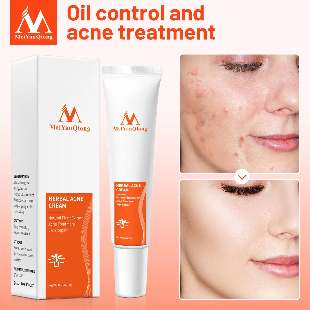 Acne Cream Acne Removal Eliminate Acne Marks Repair Damaged Skin Moisturizing Nourishing Whitening Skin Rejuvenating Face Care