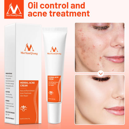 Acne Cream Acne Removal Eliminate Acne Marks Repair Damaged Skin Moisturizing Nourishing Whitening Skin Rejuvenating Face Care